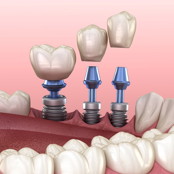 Implants, abutments, and crowns
