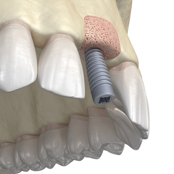 Bone grafting for an implant