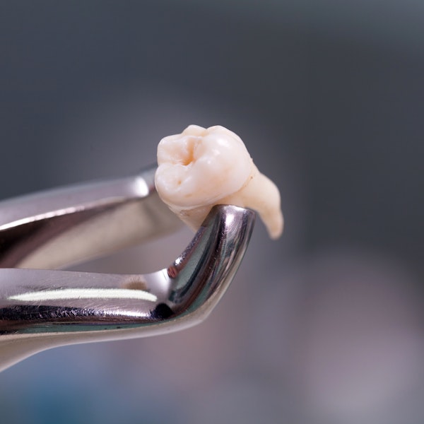 Extracted tooth